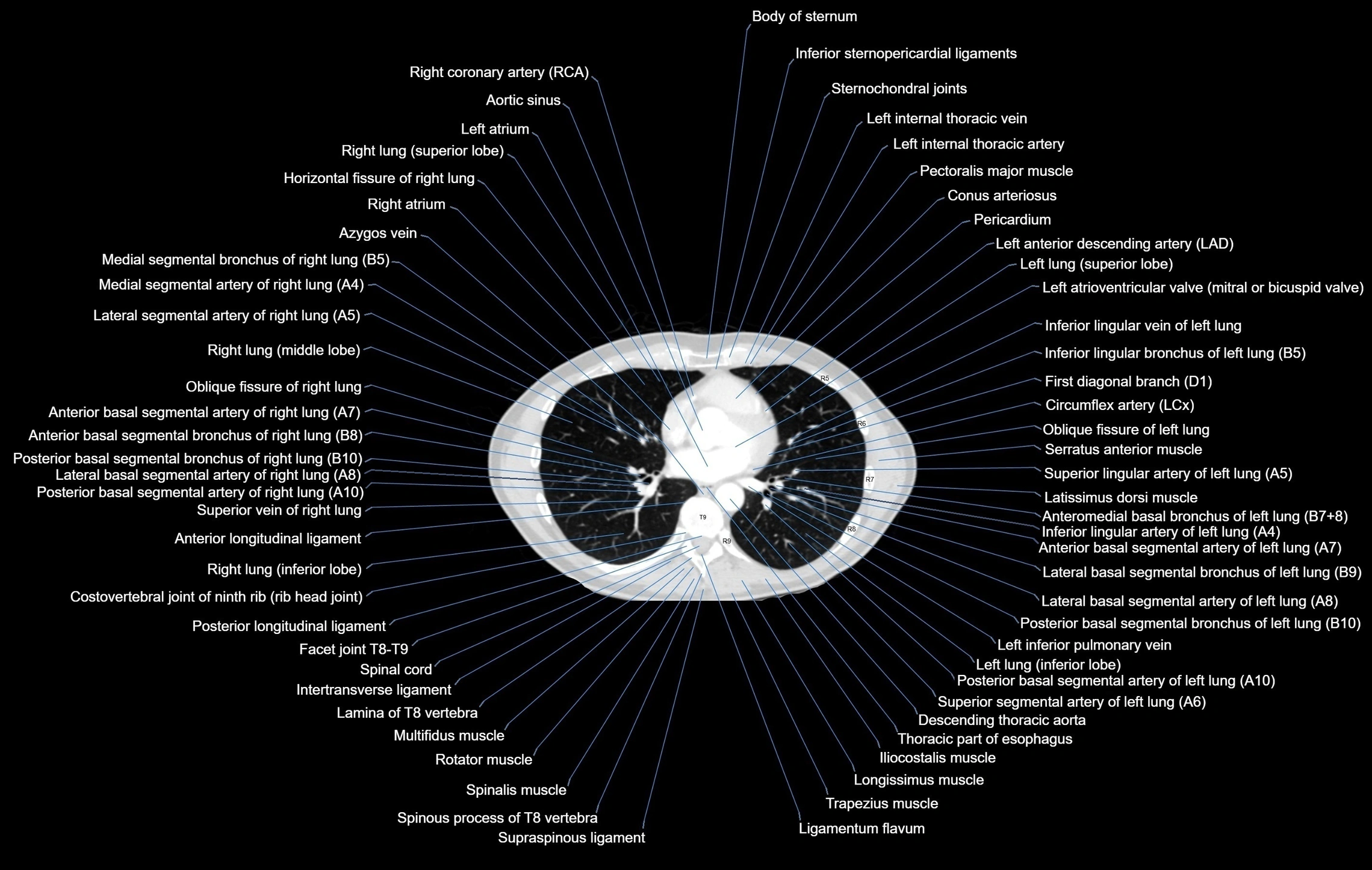CT chest (thorax) lung window window labelled axial cross sectional anatomy radiology image-00071.webp